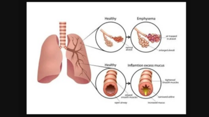 COPD-Specialist-Doctor-in-Jaipur-Rajasthan-–-Dr.-Virendra-Singh