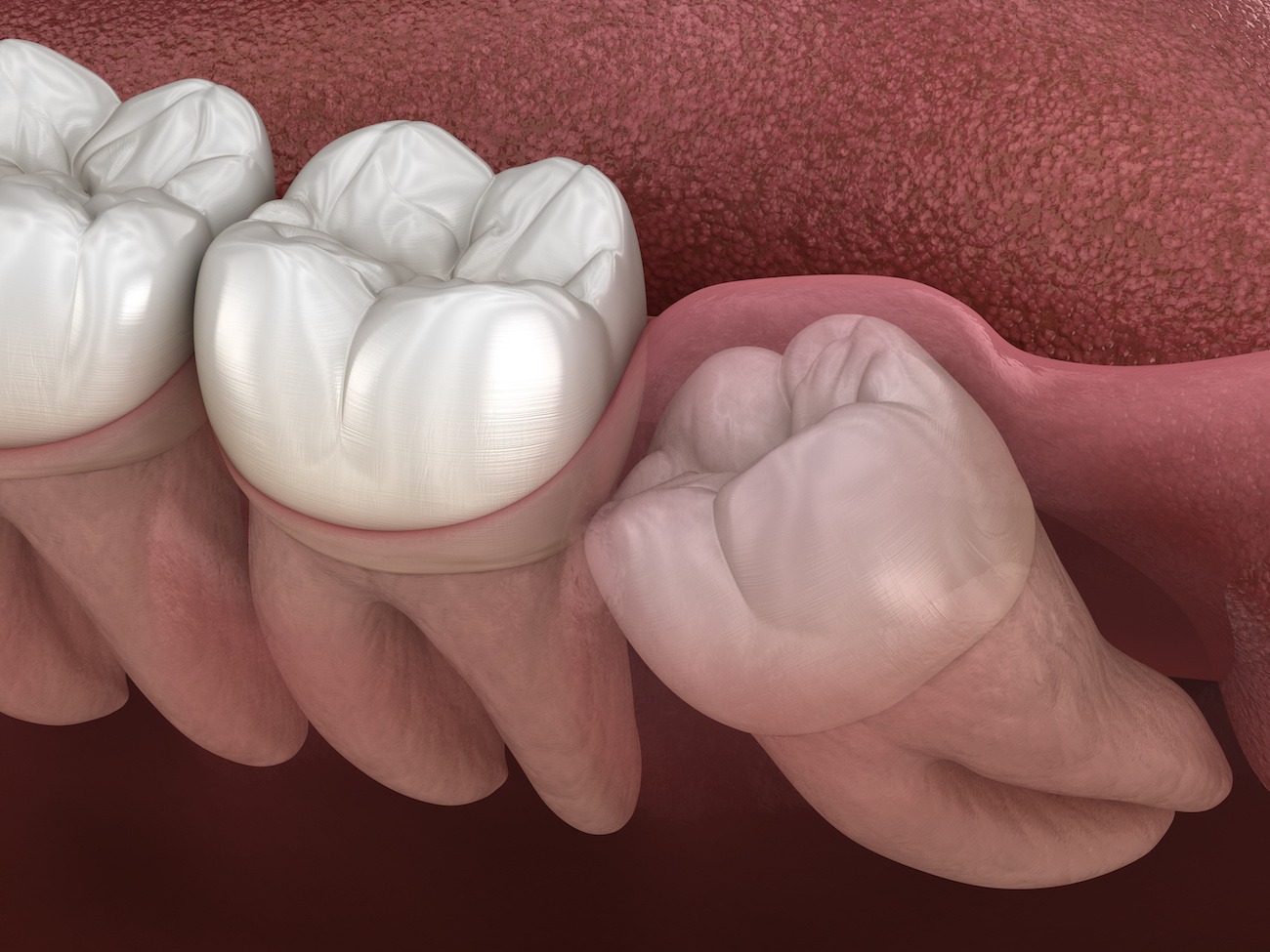 Safe and Gentle Wisdom Teeth Removal in Paradise Valley, AZ