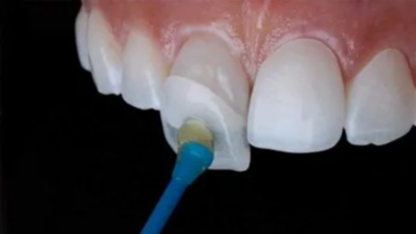 Veneers-San-Diego-at-Mesa-Dental-1