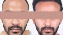 Hair Transplant in Indore | Safe & Advanced Hair Restoration
