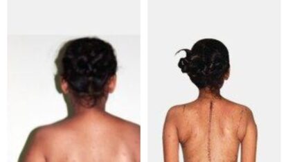 Before-and-After-Surgery