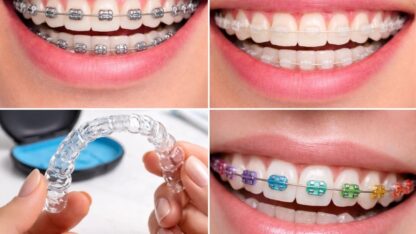 Braces-AK-Dental-Clinic