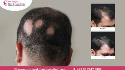 Get-the-Best-Alopecia-Treatment-in-Bangalore-for-Healthy-Hair-Dr.-Priya-Skin-and-Hair-Clinic