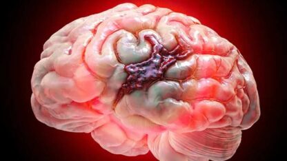 What_is_a_Brain_Hemorrhage