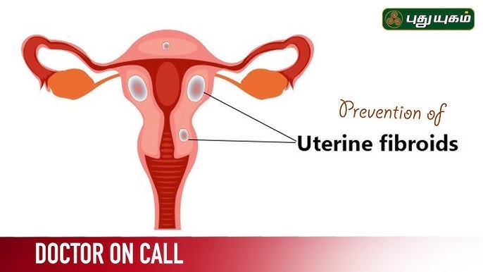 Fibroid Prevention, Symptoms & Safe Treatment Options