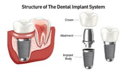Dental-Implant-Cost-1