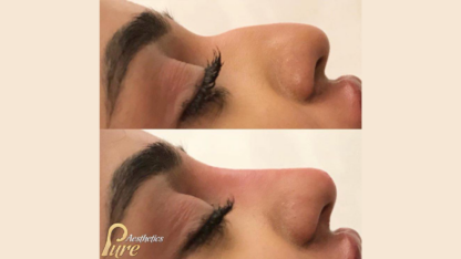 Liquid-Rhinoplasty-London