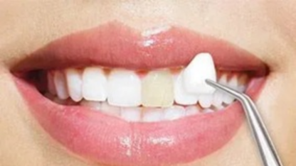 Dental-Veneers