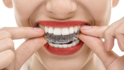 Teeth-Straightening-in-San-Diego