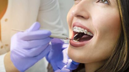 Braces-Services