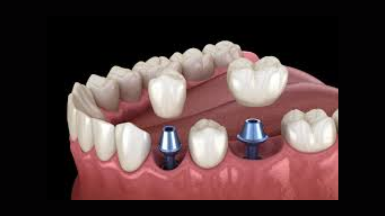 Dental Implants San Diego