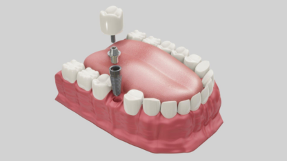 Affordable-Dental-Implants