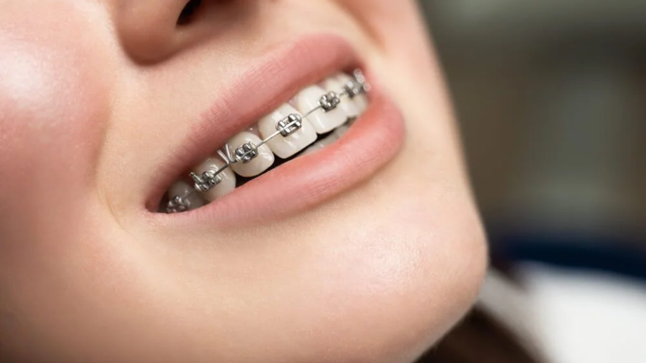 Dental Braces in Abu Dhabi City