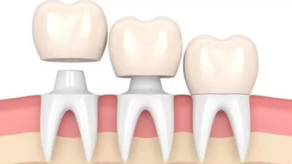 Dental-Crowns-in-Abu-Dhabi-City