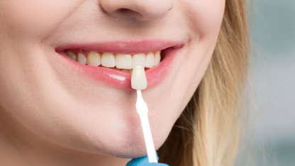 Dental-Veneers-Abu-Dhabi-City