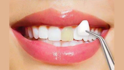 dental-veneers